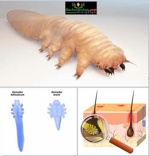  Da nhiễm corticoid là một trong những nguyên nhân gây nên demodex!