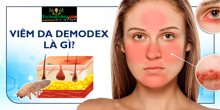 Da bị viêm nhiễm nặng nề do nhiễm Demodex!