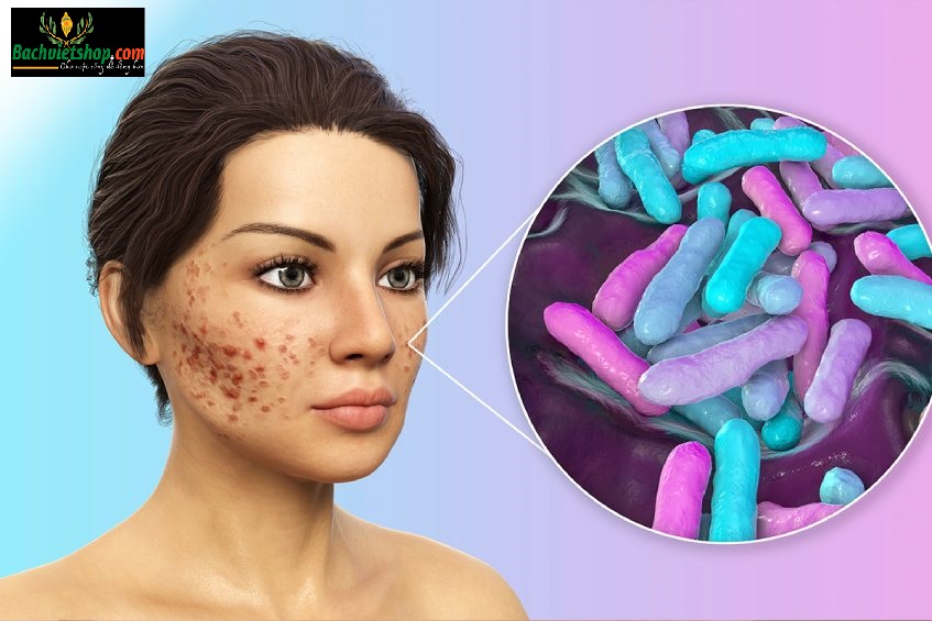 Vi khuẩn P. acne (Propionibacterium acnes) là nguyên nhân chính gây ra các loại mụn thường gặp!